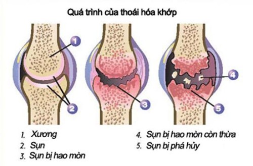 5 Cách Đơn Giản Bảo Vệ Sức Khỏe Xương Khớp